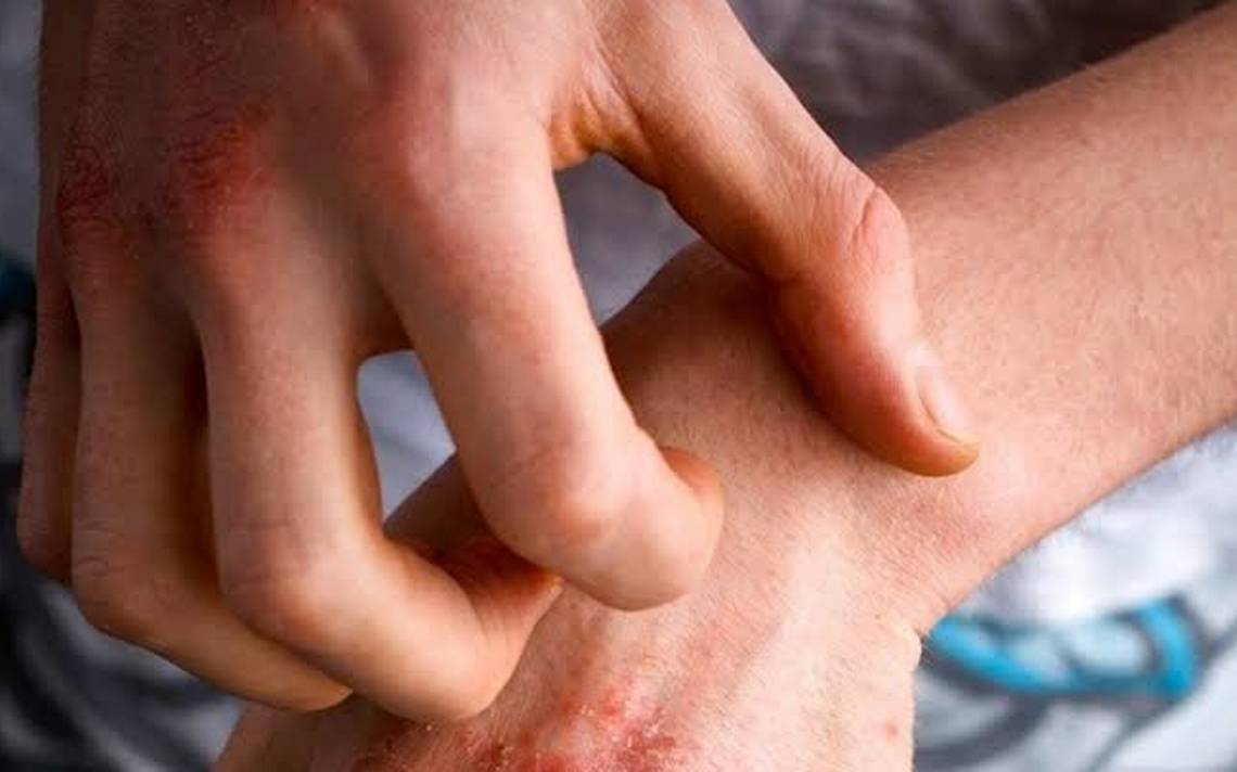 En México, 3 de cada 10 adolescentes padecen dermatitis atópica –  Mundodehoy.com